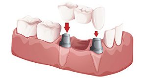 Porcelain-Crowns-Bridge