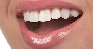 porcelain-veneers